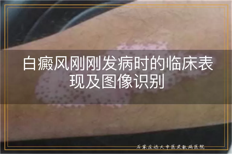 白癜风刚刚发病时的临床表现及图像识别