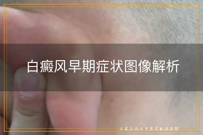 白癜风早期症状图像解析