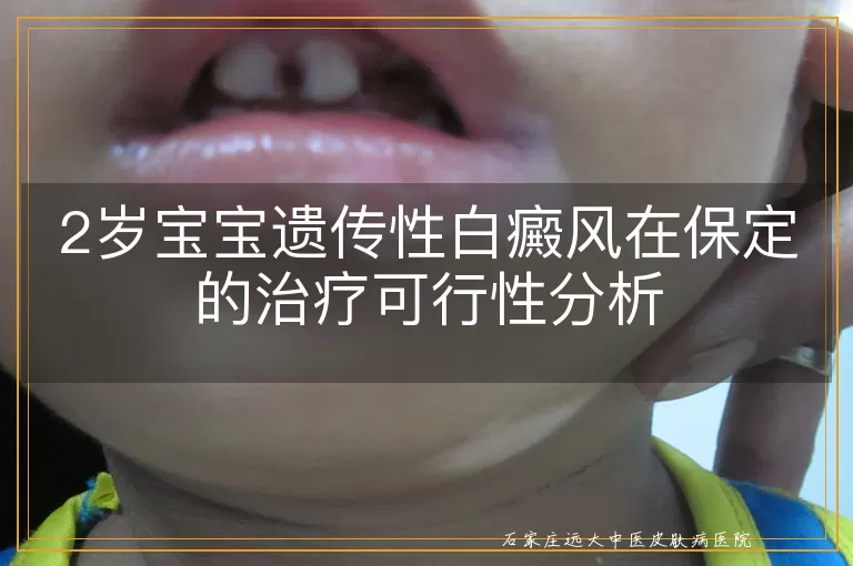 2岁宝宝遗传性白癜风在保定的治疗可行性分析