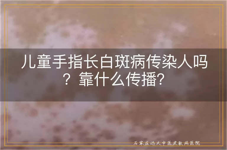 儿童手指长白斑病传染人吗？靠什么传播？