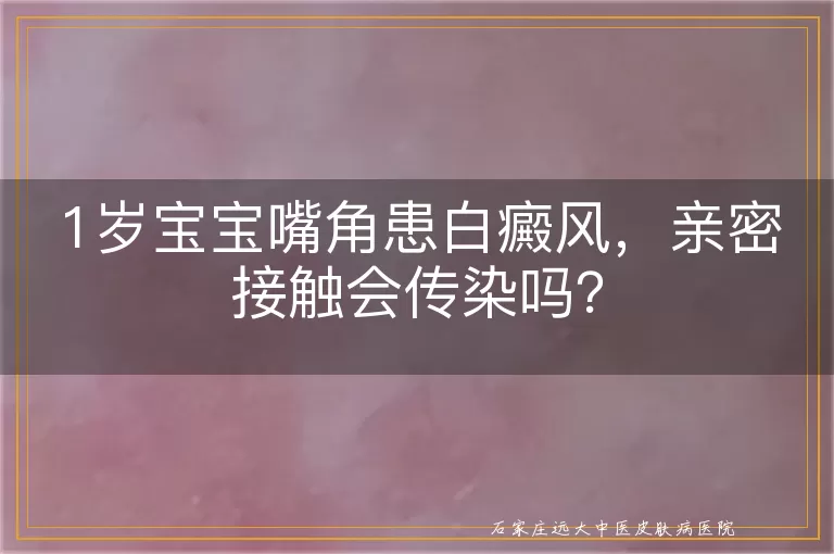 1岁宝宝嘴角患白癜风，亲密接触会传染吗？