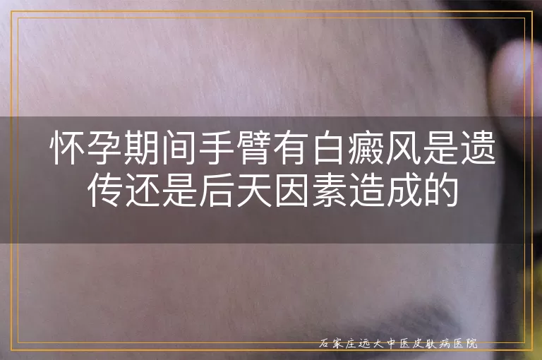 怀孕期间手臂有白癜风是遗传还是后天因素造成的