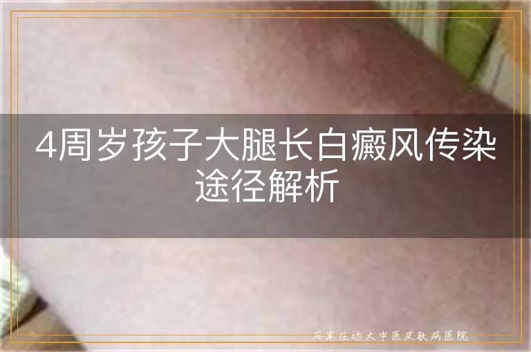 4周岁孩子大腿长白癜风传染途径解析