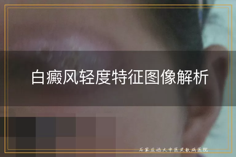 白癜风轻度特征图像解析