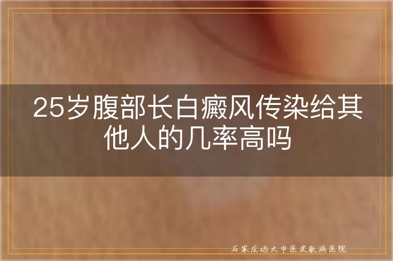 25岁腹部长白癜风传染给其他人的几率高吗