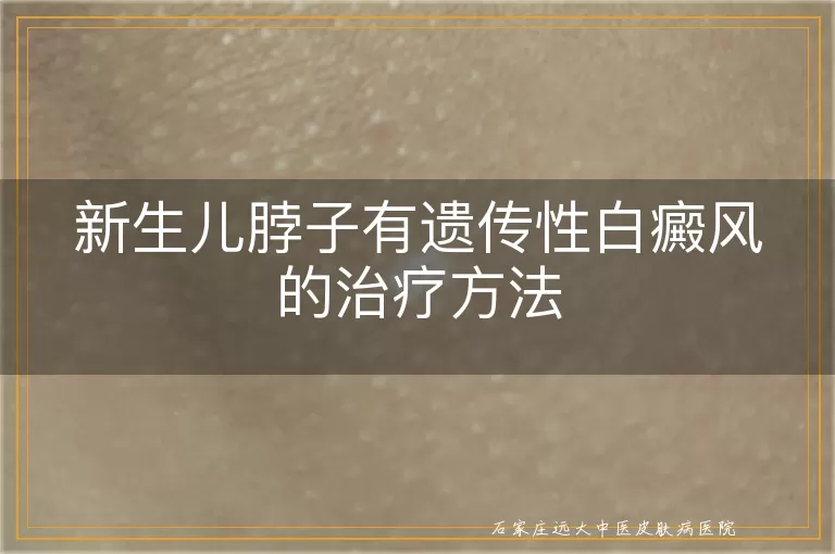 新生儿脖子有遗传性白癜风的治疗方法
