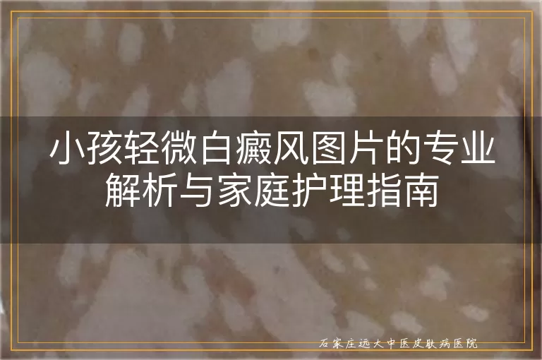 小孩轻微白癜风图片的专业解析与家庭护理指南