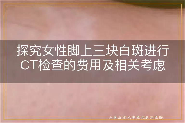 探究女性脚上三块白斑进行CT检查的费用及相关考虑