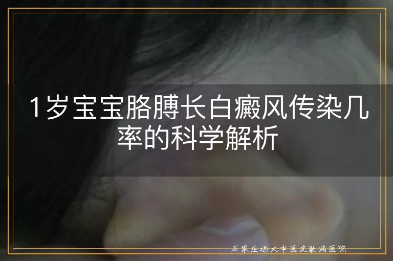 1岁宝宝胳膊长白癜风传染几率的科学解析