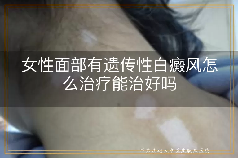 女性面部有遗传性白癜风怎么治疗能治好吗