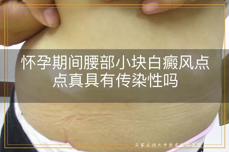 怀孕期间腰部小块白癜风点点真具有传染性吗