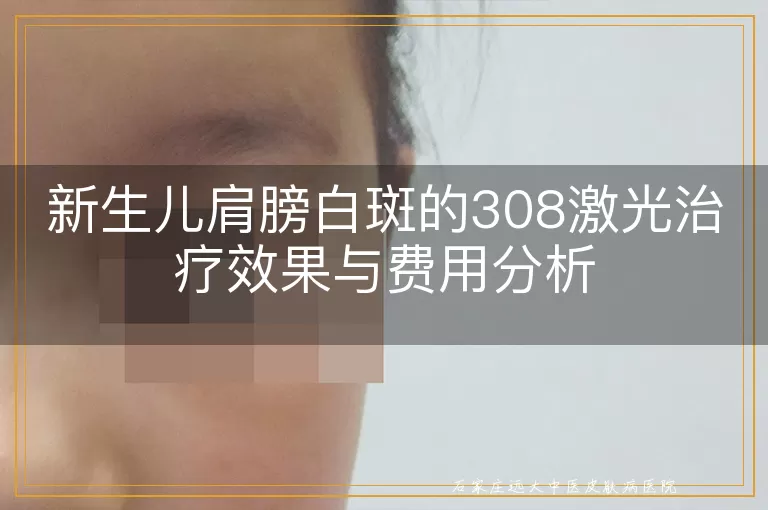新生儿肩膀白斑的308激光治疗效果与费用分析
