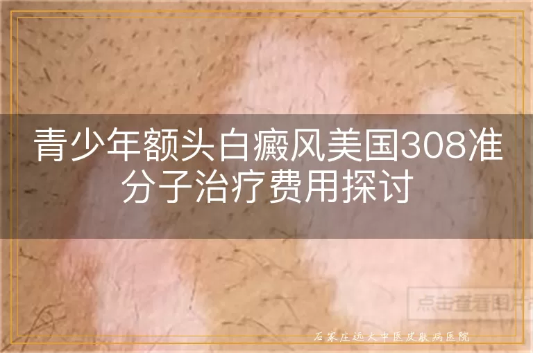 青少年额头白癜风美国308准分子治疗费用探讨