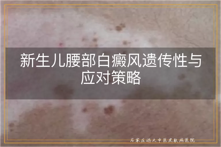 新生儿腰部白癜风遗传性与应对策略