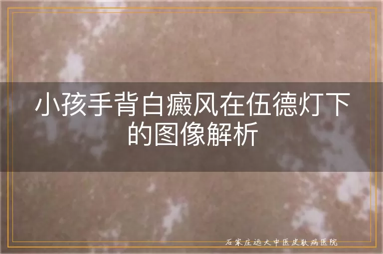 小孩手背白癜风在伍德灯下的图像解析