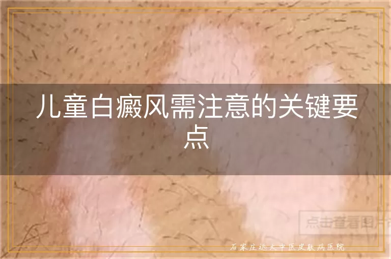 儿童白癜风需注意的关键要点
