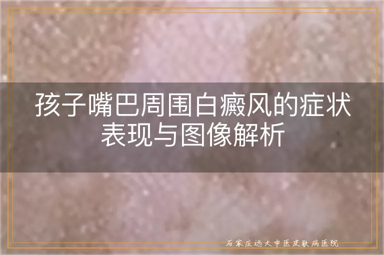 孩子嘴巴周围白癜风的症状表现与图像解析