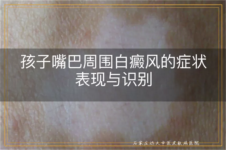 孩子嘴巴周围白癜风的症状表现与识别