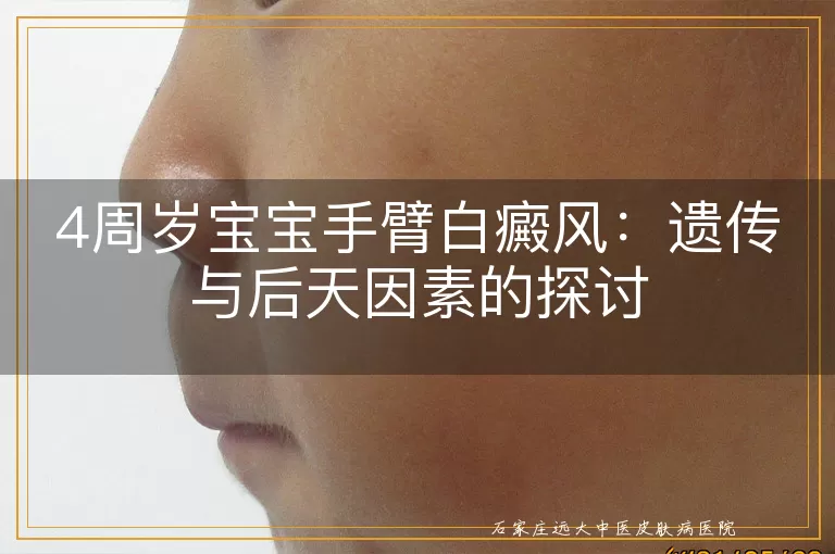 4周岁宝宝手臂白癜风：遗传与后天因素的探讨