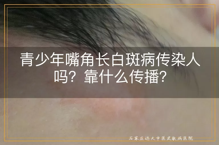 青少年嘴角长白斑病传染人吗？靠什么传播？