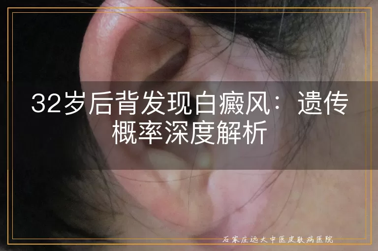 32岁后背发现白癜风：遗传概率深度解析