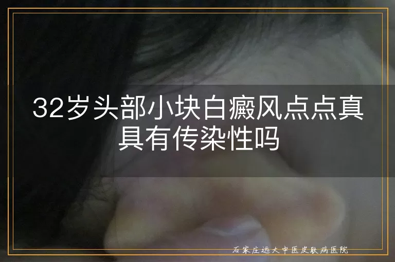 32岁头部小块白癜风点点真具有传染性吗