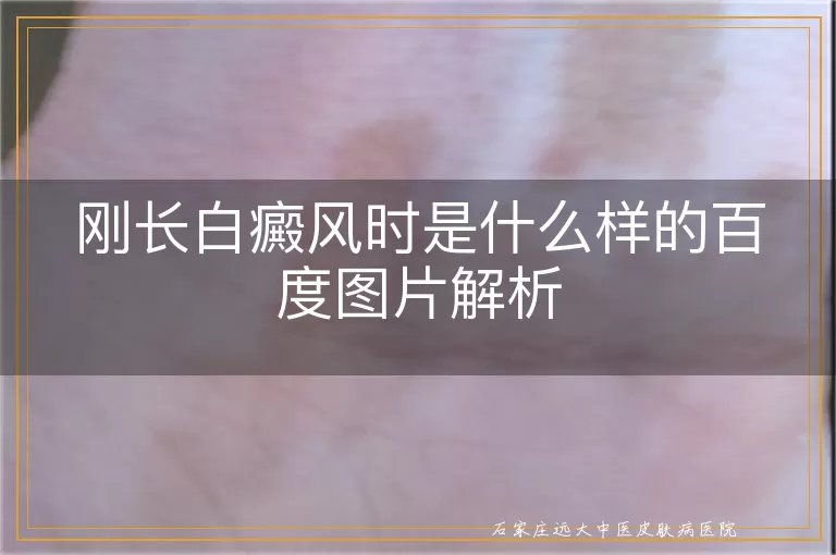 刚长白癜风时是什么样的百度图片解析