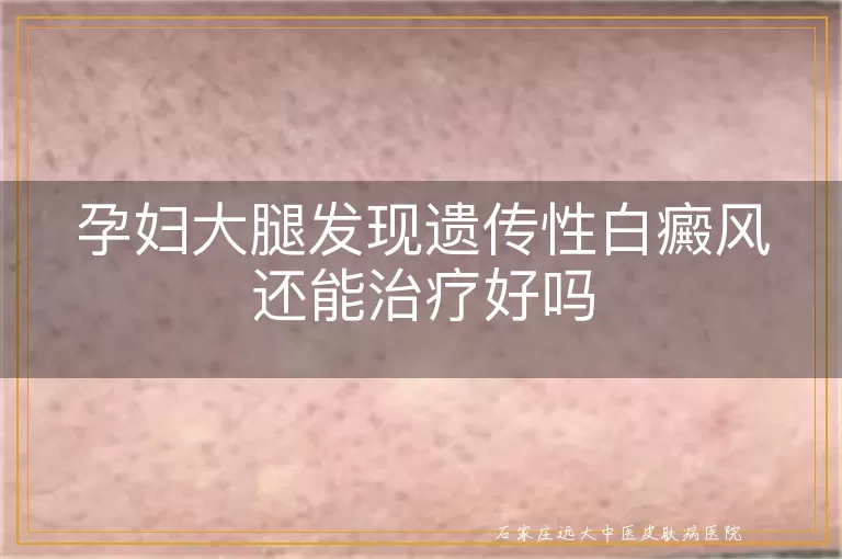 孕妇大腿发现遗传性白癜风还能治疗好吗