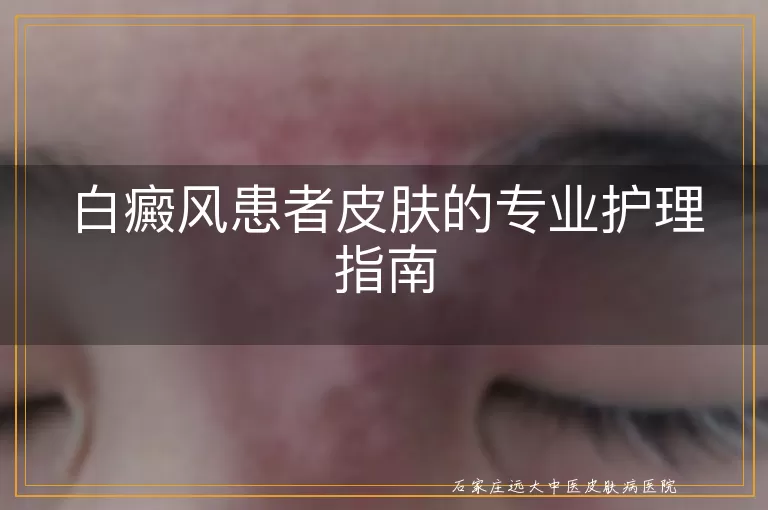 白癜风患者皮肤的专业护理指南