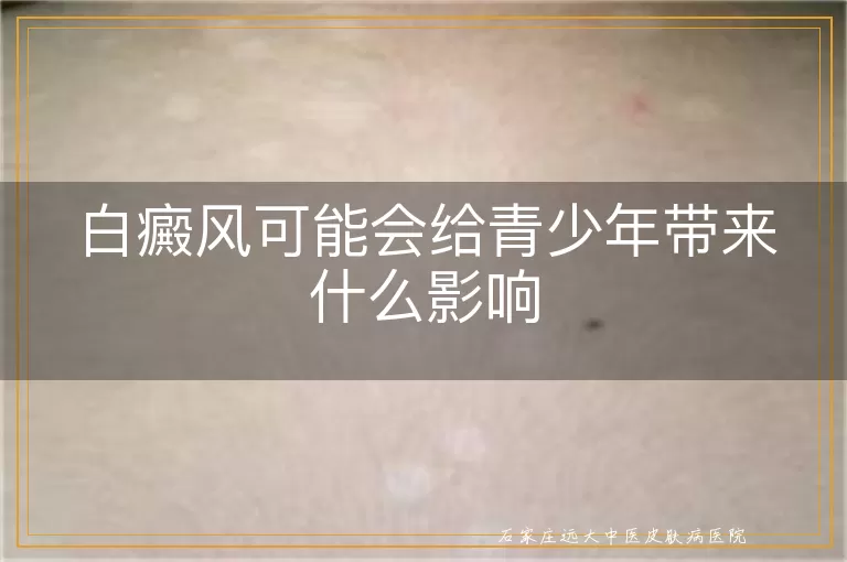 白癜风可能会给青少年带来什么影响