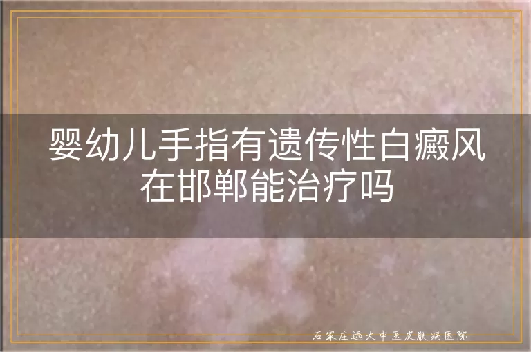 婴幼儿手指有遗传性白癜风在邯郸能治疗吗