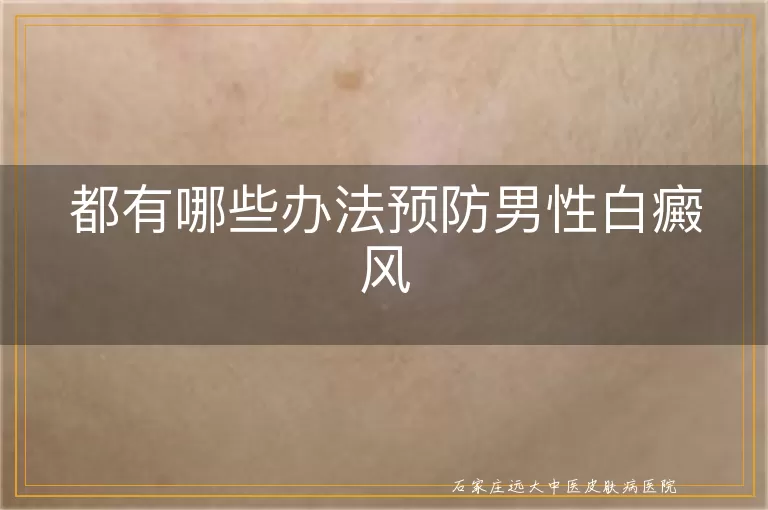 都有哪些办法预防男性白癜风