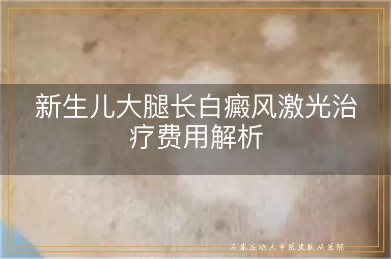 新生儿大腿长白癜风激光治疗费用解析