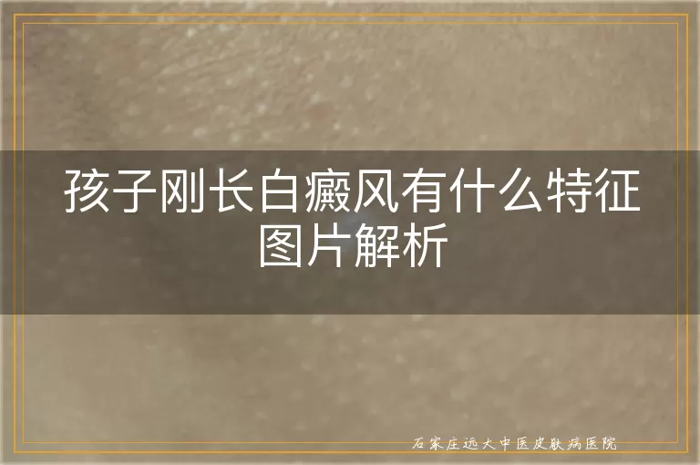 孩子刚长白癜风有什么特征图片解析