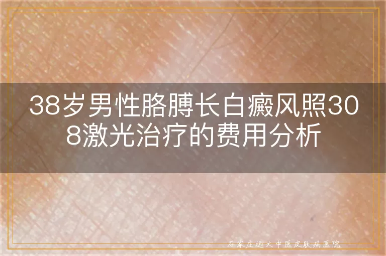 38岁男性胳膊长白癜风照308激光治疗的费用分析