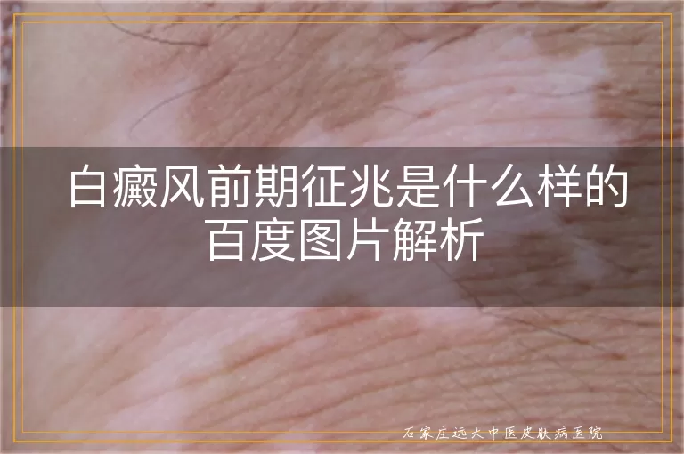 白癜风前期征兆是什么样的百度图片解析