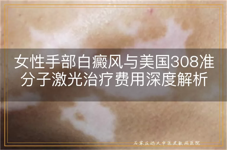女性手部白癜风与美国308准分子激光治疗费用深度解析
