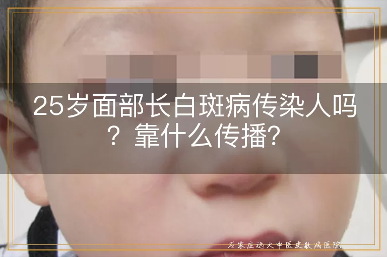 25岁面部长白斑病传染人吗？靠什么传播？