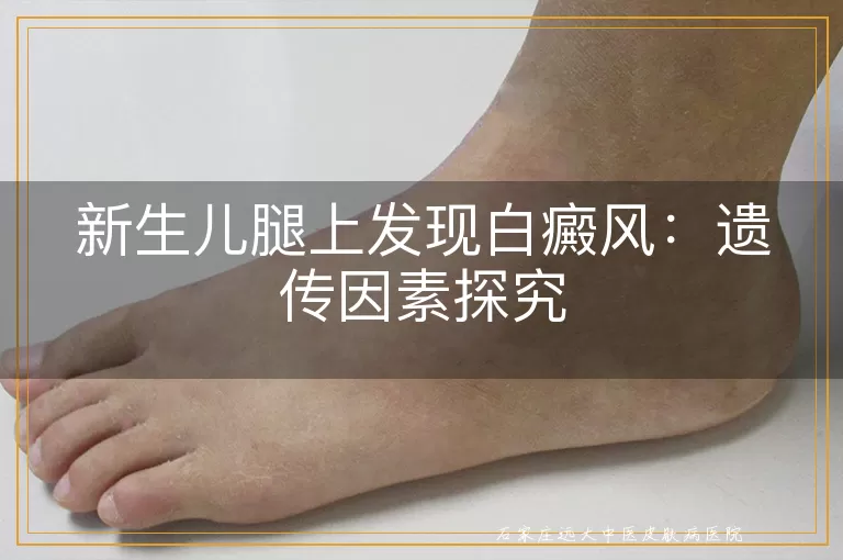 新生儿腿上发现白癜风：遗传因素探究