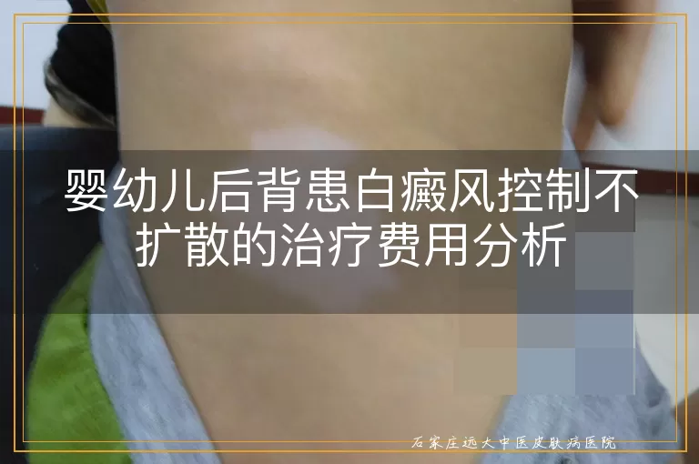 婴幼儿后背患白癜风控制不扩散的治疗费用分析