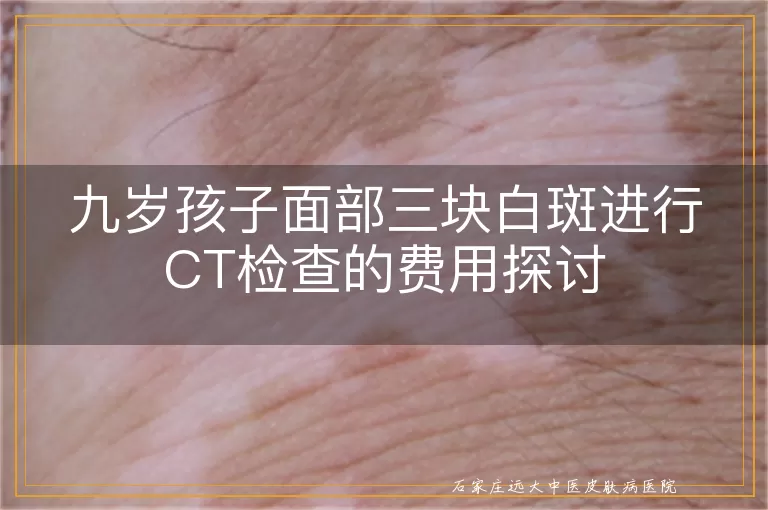 九岁孩子面部三块白斑进行CT检查的费用探讨
