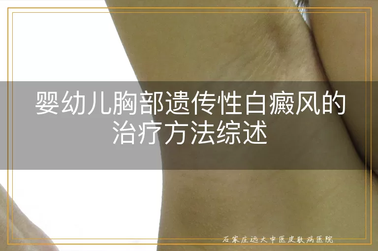 婴幼儿胸部遗传性白癜风的治疗方法综述