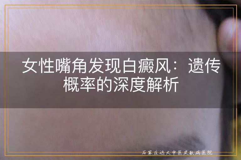 女性嘴角发现白癜风：遗传概率的深度解析