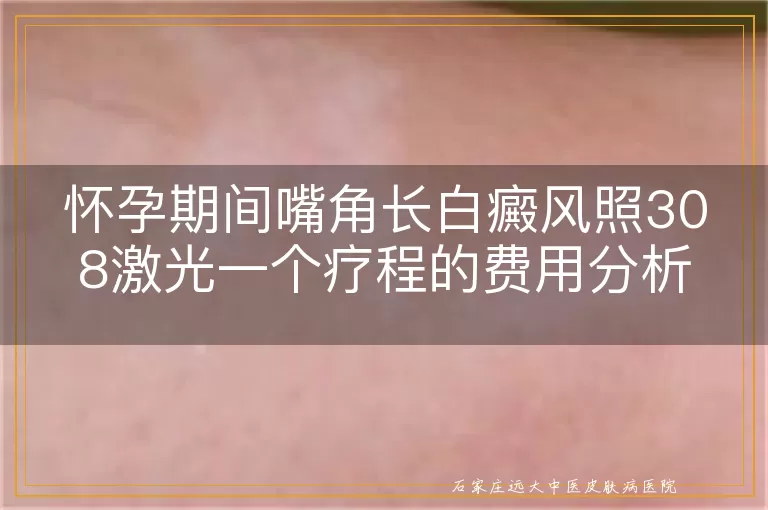 怀孕期间嘴角长白癜风照308激光一个疗程的费用分析