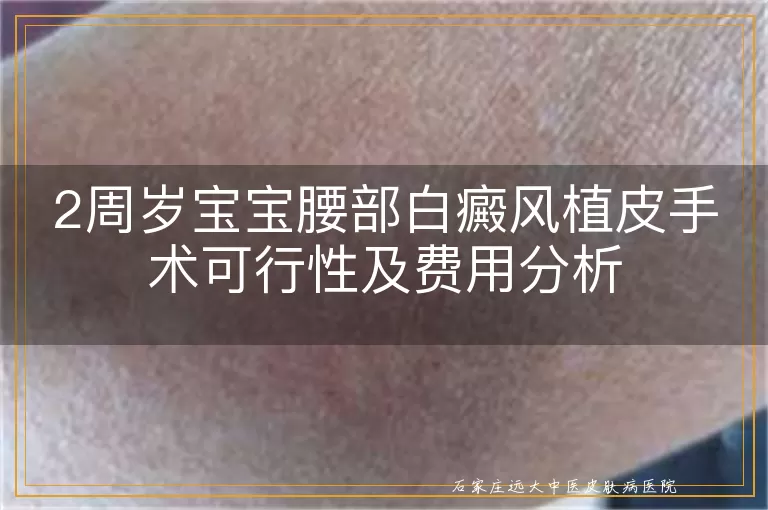 2周岁宝宝腰部白癜风植皮手术可行性及费用分析