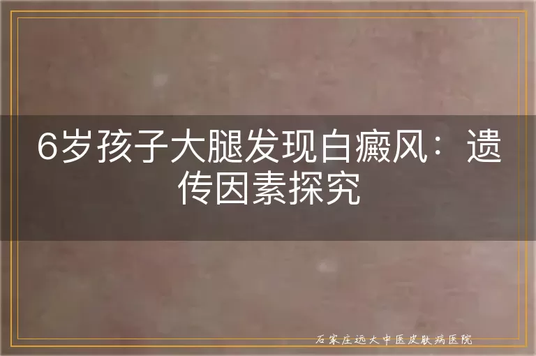 6岁孩子大腿发现白癜风：遗传因素探究