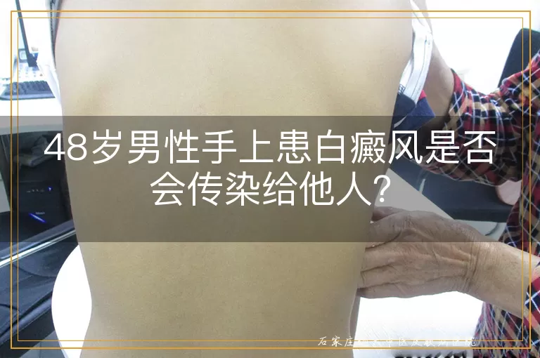 48岁男性手上患白癜风是否会传染给他人？