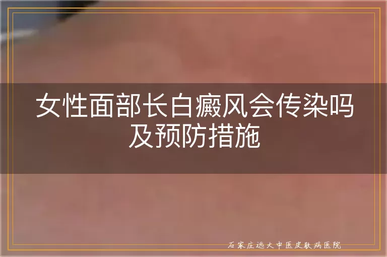 女性面部长白癜风会传染吗及预防措施