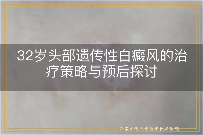 32岁头部遗传性白癜风的治疗策略与预后探讨