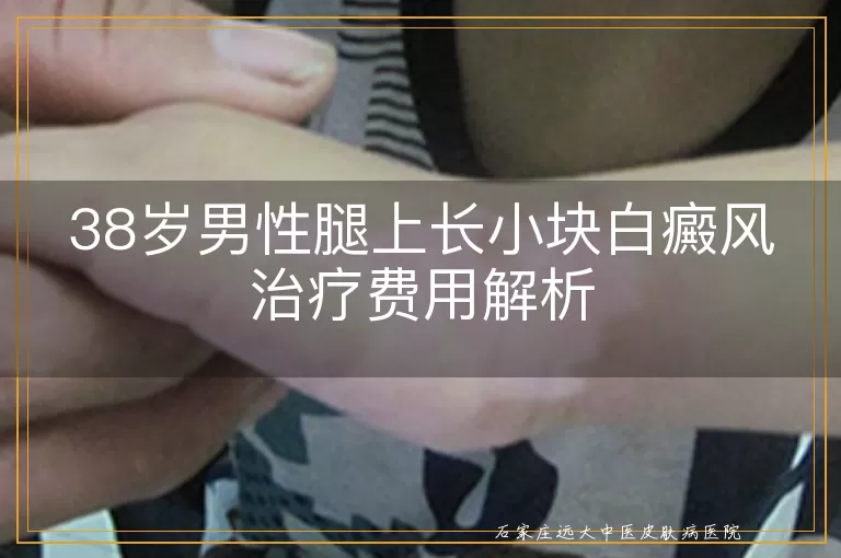 38岁男性腿上长小块白癜风治疗费用解析